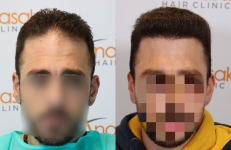 hairloss experiences photo collage (1).png