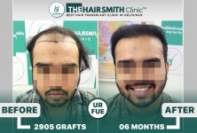 6 months hairsmith hair transplant result - The Hairsmith Clinic - #HairTransplant #The Hairms...JPG