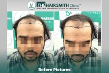 Before Hair Transplant HS 840- The Hairsmith Clinic Delhi India #HairTransplant.JPG
