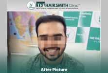 after hair transplant result - the hairsmith clinic delhi india #HairTransplant #URFUEHairTran...jpg
