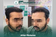 after hair transplant result - the hairsmith clinic delhi india #HairTransplant #URFUEHairTran...jpg