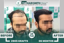 6 months hairsmith hair transplant result - The Hairsmith Clinic - #HairTransplant #The Hairms...JPG