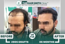 6 months hairsmith hair transplant result - The Hairsmith Clinic - #HairTransplant #The Hairms...JPG