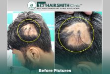 Before Image - The Hairsmith Clinic Delhi India.JPG