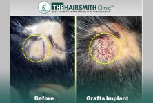 Grafts Implant - Hairsmith Hair Transplant.jpg