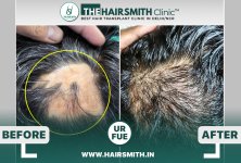 burn scar hair transplant result - the hairsmith clinic - best hair transplant clinic.JPG