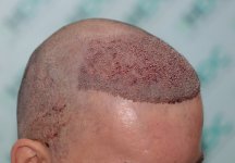 2. Post op 3800 Grafts - Recipient.JPG