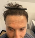6. Hairline result - Front.jpeg