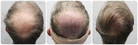 hair-transplant-12-months-result-glasgow-dr-bonaros (54) (1).jpg