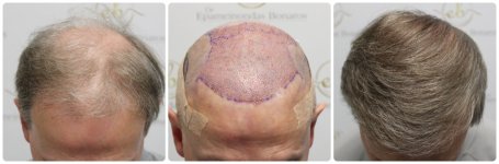 hair-transplant-12-months-result-glasgow-dr-bonaros (56) (1).jpg