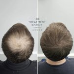 1380-Grafts-FUE-Crown-Hair-Transplant-Before-and-After.jpeg