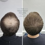 FUE-Crown-Hair-Transplant-Before-and-After-1380-grafts.jpeg