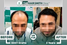 24 months hairsmith hair transplant result - The Hairsmith Clinic - #HairTransplant #The Hairm...JPG