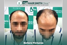Before Hair Transplant HS 841- The Hairsmith Clinic Delhi India #HairTransplant.JPG