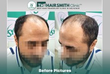 Before Hair Transplant HS 841 - The Hairsmith Clinic Delhi India #HairTransplant #URFUEHairTra...JPG