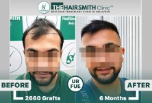 the hairsmith clinic hair transplant result #hairtransplant.JPG