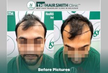 Before Hair Transplant HS 842- The Hairsmith Clinic Delhi India - #hairtransplant.jpg