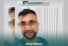 6 months hairsmith hair transplant result - the hairsmith clinic delhi #hairtransplant.jpg