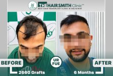 the hairsmith clinic hair transplant result #hairtransplant #hairsmithhairtransplant.jpg