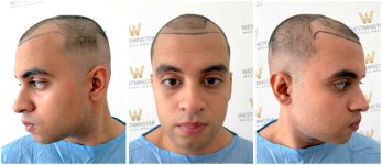 WMG FUE Hair Transplant Pre Op.jpg