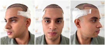 WMG FUE Hair Transplant Post Op.jpg