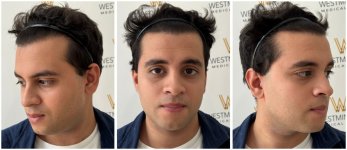 WMG FUE Hair Transplant 12 Months.jpg