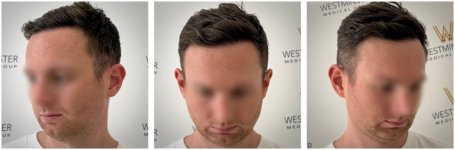 WMG London FUE Hair Transplant Post Op.jpg