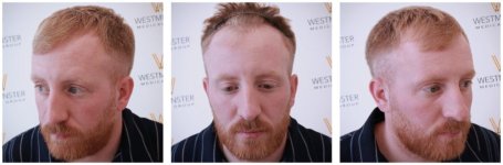 WMG London Hair Transplant Before copy.jpg