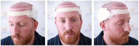 WMG London Hair Transplant Post-Op copy.jpg