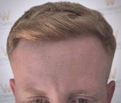 WMG-London-Hair-Transplant-Close-Up.jpg