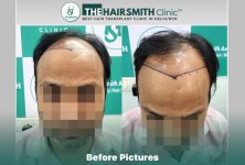 Before Hair Transplant HS 843- The Hairsmith Clinic Delhi India - #hairtransplant.jpg