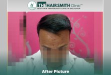 14 months hairsmith hair transplant result - the hairsmith clinic delhi #hairtransplant.JPG