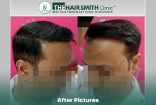 14 months hairsmith hair transplant result - the hairsmith clinic delhi #hairtransplant #theha...JPG