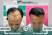 the hairsmith clinic hair transplant result #hairtransplant #hairsmithhairtransplant.jpg