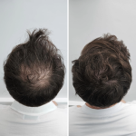 HD_before_After-4.png