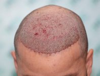 6. Post op 4100 Grafts on 06-08-25.JPG