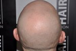 before treatment back.jpg