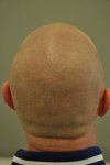 after treatment back 1.jpg