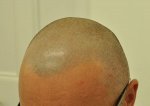 4. after 2 session left side.jpg