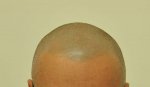 6. after 2 sessions settled treatment.jpg