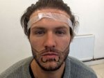 Kyle-Christie-Beardtransplant-done-by-Dr-Kumari-at-The-Liverpool-Skin-And-Hair-Transplant (1).jpg