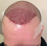 Immediately post fue.JPG