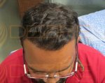 Hair Transplant Photos.JPG