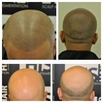 Shak hair loss journey .jpg