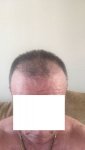 Post Surgery 4 months 1.jpg