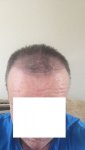 Post Surgery 4 months 2.jpg