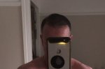 Post Surgery 5.5 months 3.jpg