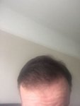 Post Surgery 7 months 1.jpg