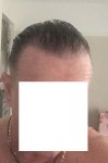Post Surgery 12 months 1.jpg