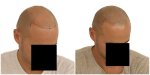 Jason voor en na 2 behandelingen rechts.jpg